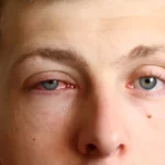  ¿Tus ojos están rojos? Lo que debes saber sobre la conjuntivitis